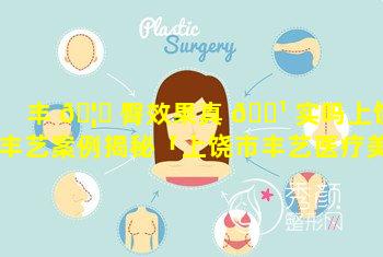 丰 🦋 臀效果真 🌹 实吗上饶丰艺案例揭秘「上饶市丰艺医疗美容图片大全」